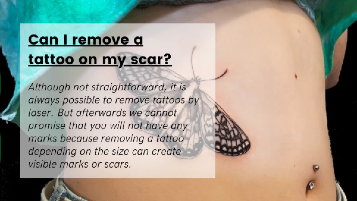 Can-I-remove-a-tattoo-on-my-scar_-600x338